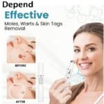 Mole And Wart Removal Pen Non Invasive Mole And Wart Removal